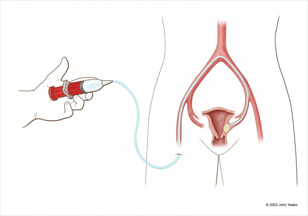 Uterine artery embolization model